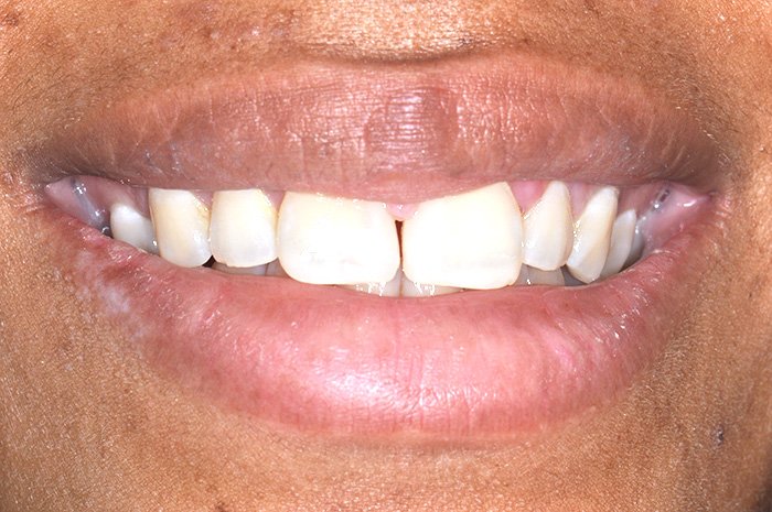 e-chantier-dental-clinic-dental-services-before-n-after-img